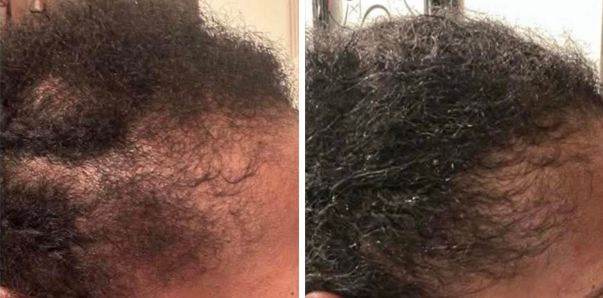 NuGrowth Hair Growth Oil — Root-Restoring Nutrition for Fuller, More Resilient Hair - Image 4